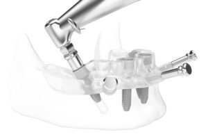 surgical implant guide